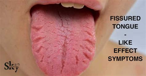 Fissured tongue is the medical term for a crack down the middle of the. . Fissured tongue nhs